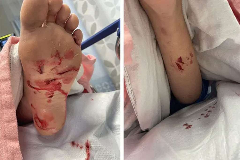 The move comes along with an increase in shark sightings and well-publicized attacks, like the one on teenager Maggie Drozdowski earlier this week (bite marks pictured) in Stone Harbor, NJ.